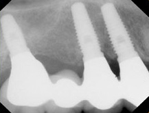Dental Bridge X-Ray