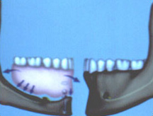 The implant retained denture