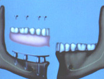 A bar-retained overlay denture supported on four implants