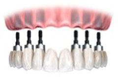 overdenture