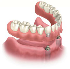 overdenture
