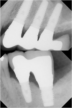 X-ray of Same Bridges 5 Years After Final Restoraton