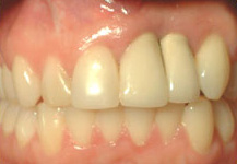 Results from Bone Graft
