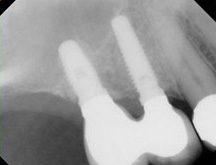 Sinus Lift X-ray